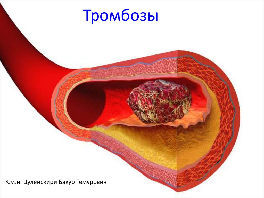 Тромбоз артерия и вена. Тромбы в сосудах пальцев рук. Микротромбоз сосудов пальца.
