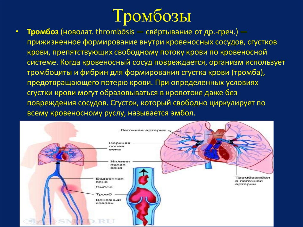 Артериальный и венозный тромбоз. Тромбоза вен печени