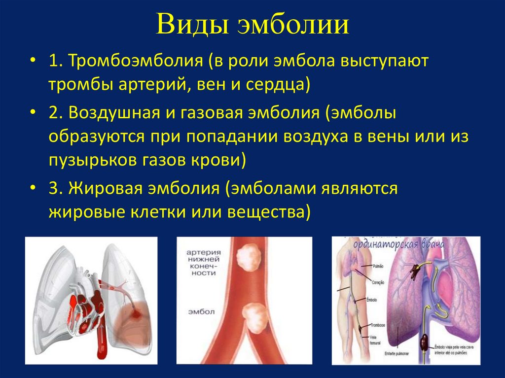 Тромбоз артерия и вена. Виды эмболии. Виды тромбоэмболии.