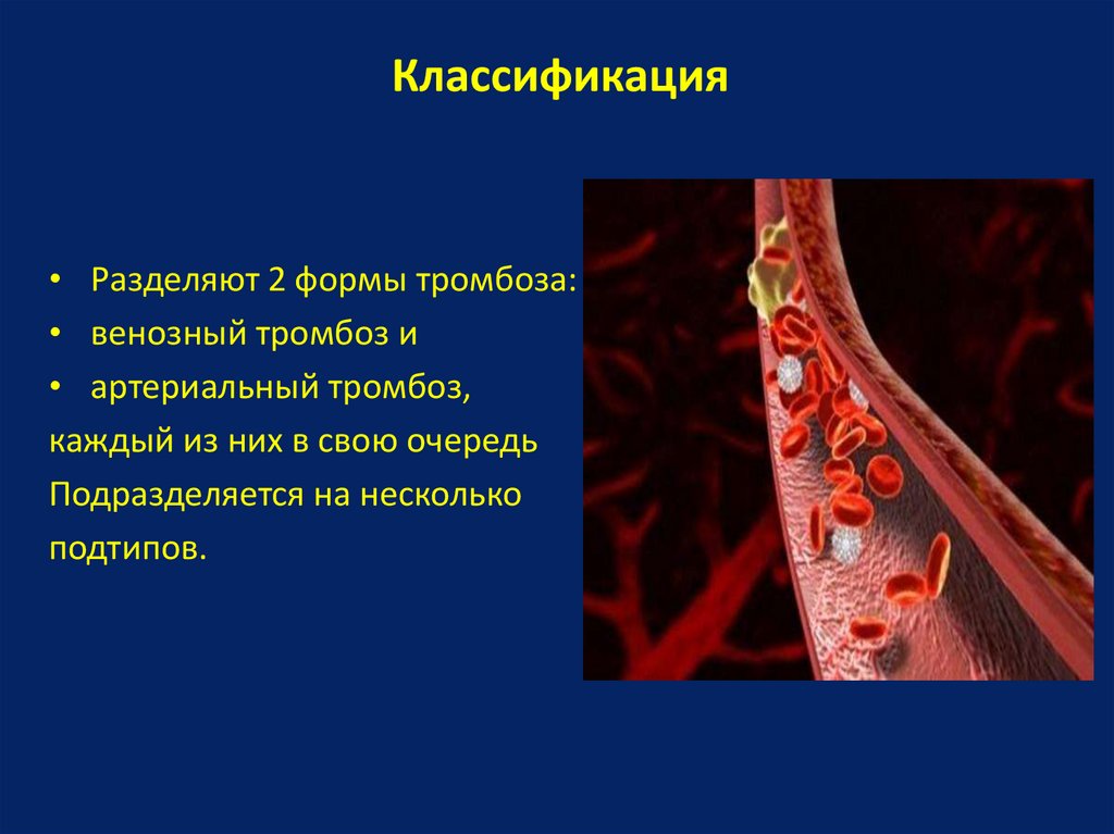 Артериальная тромбоэмболия. Классификация тромбозов. Артериальный тромбоз классификация. Классификация тромбов по форме.