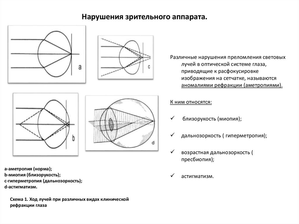 Рефракция глаза характеристика изображения на сетчатке