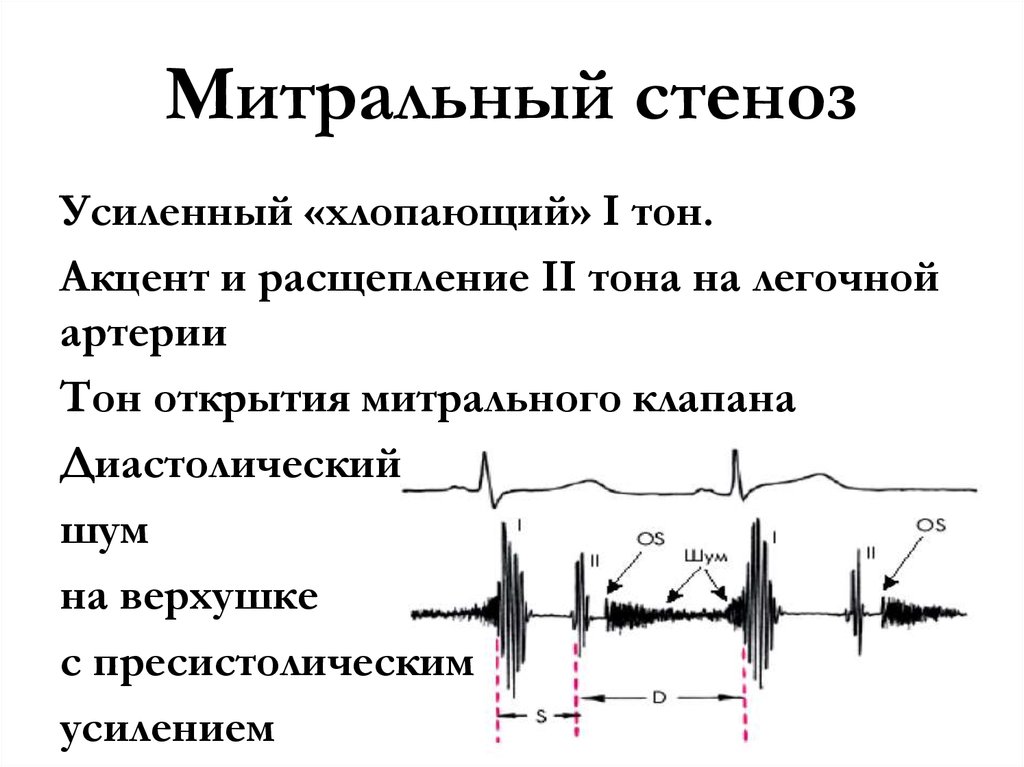 Аускультативная картина при митральном стенозе сердца включает на верхушке