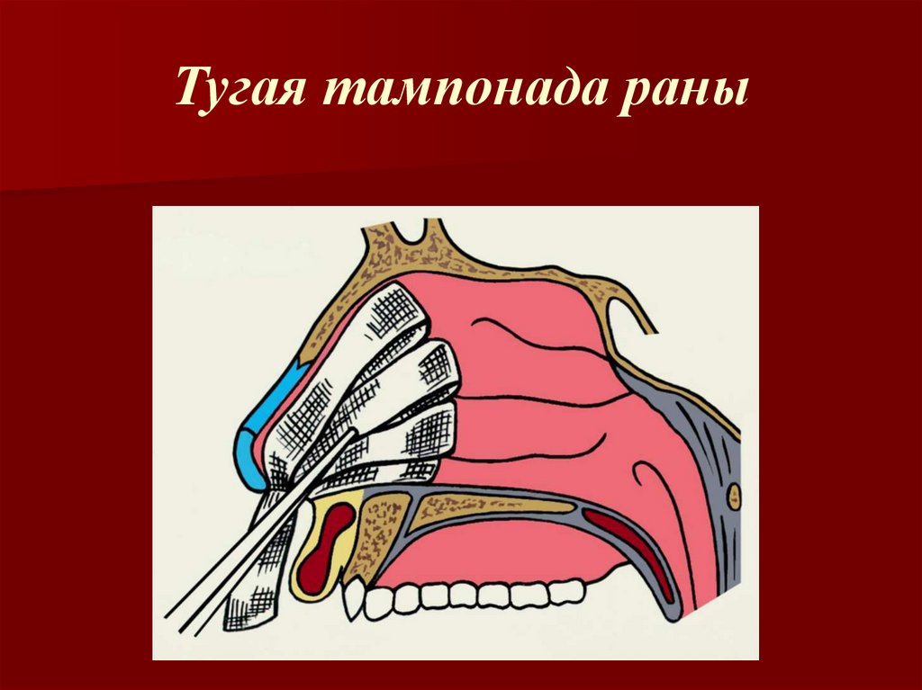 Тампонада. Тугое тампонирование раны. Остановка кровотечения тампонада. Инструменты для тампонады раны.