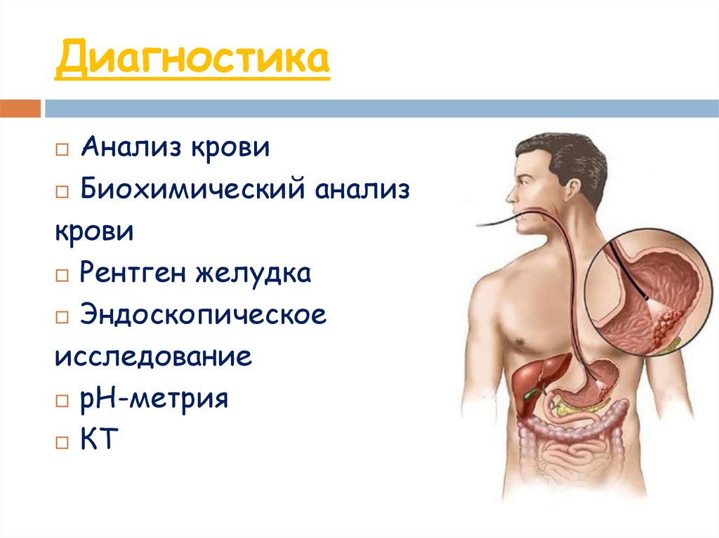 Болезнь Менетрие - презентация онлайн