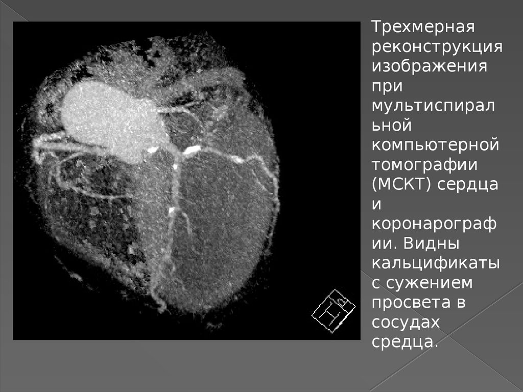 Исследование коронарного кальция. Кт коронарография аномалии коронарных артерий. Кт коронарография сосудов сердца. Мультиспиральная кт коронарных сосудов. Мультиспиральная кт сердца сосудов сердца.