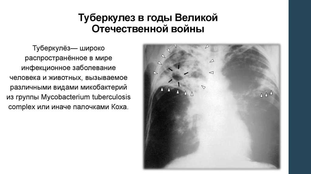 Туберкулез в годы Великой Отечественной войны