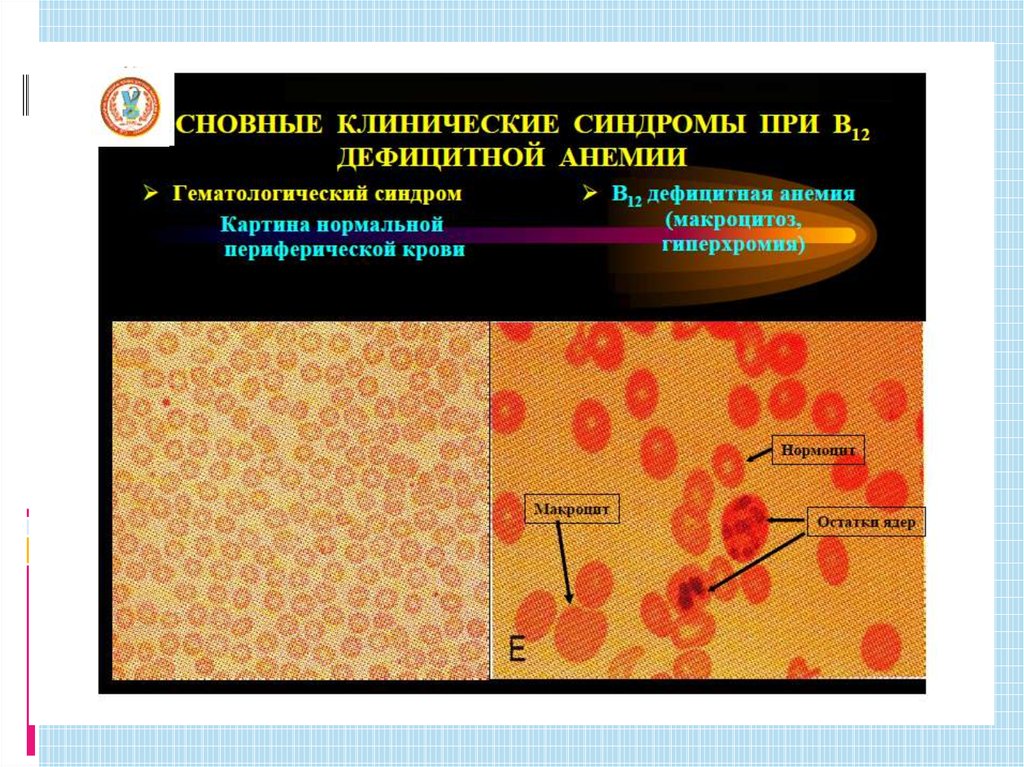 Фолиеводефицитная анемия картинки