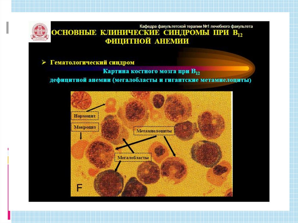 В12 дефицитная анемия презентация