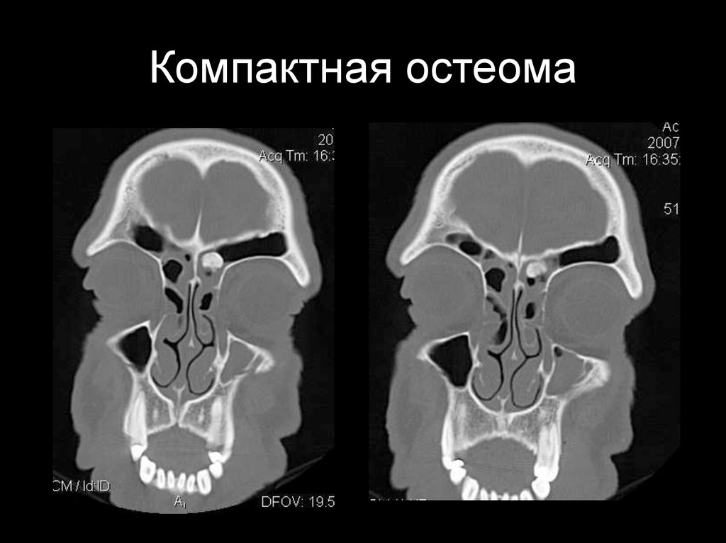 Компактная остеома фото