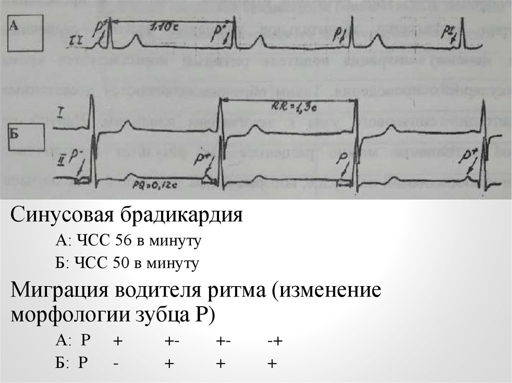 Карта вызова слабость синусового узла