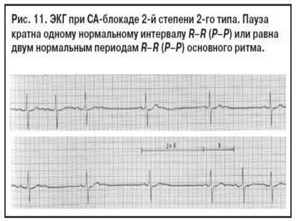 Синусовая брадикардия сердца у подростка