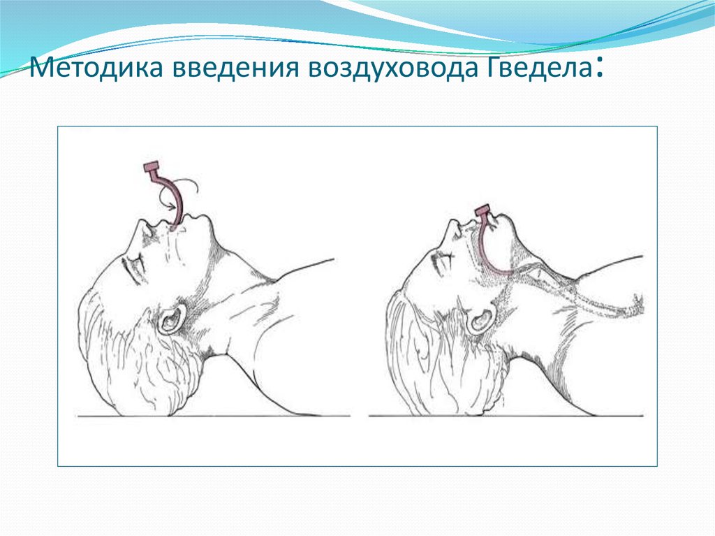 Методика введения. Введение воздуховода алгоритм. Воздуховод Гведела Введение. Постановка воздуховода Гведела. Введение орофарингеального воздуховода.