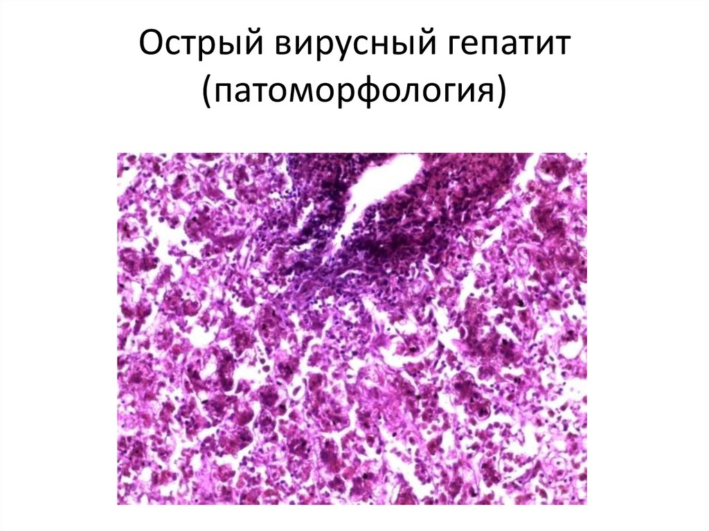 Острый вирусный гепатит (патоморфология)