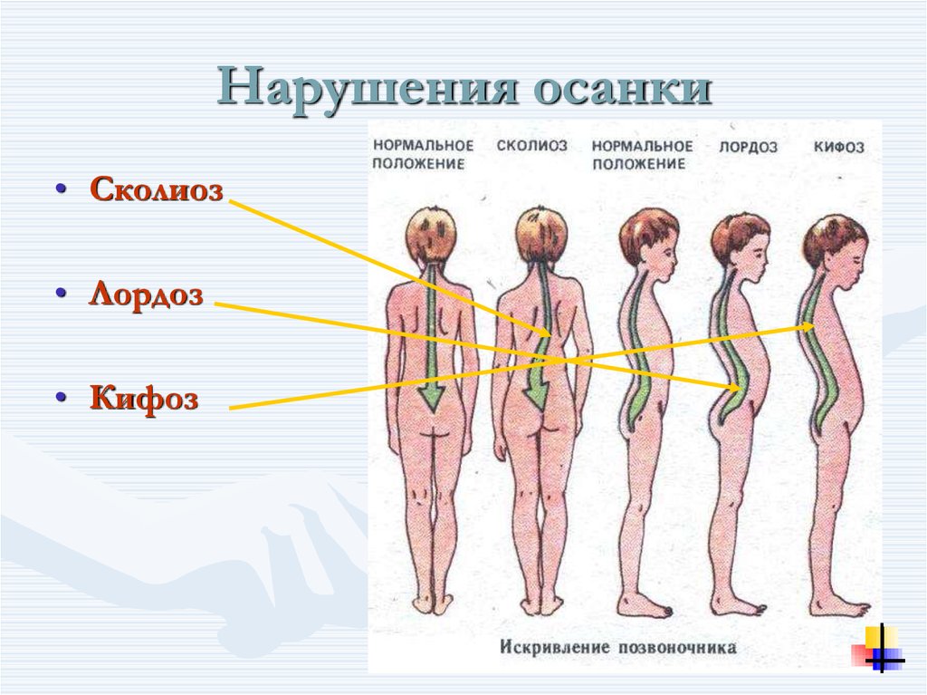 Как называется нарушение осанки изображенное на рисунке 2