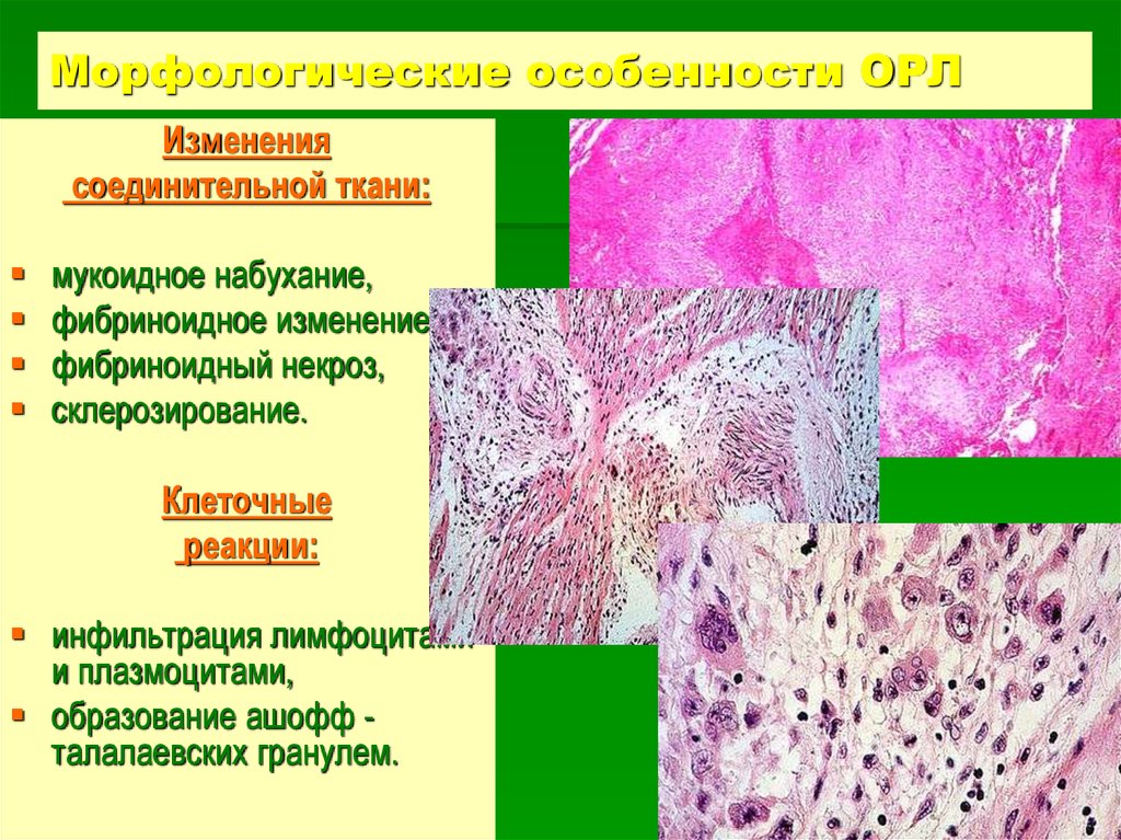 Морфологические изменения болезни. Фибриноидный некроз соединительной ткани. Гранулема Ашоффа гистология. Фибриноидное набухание соединительной ткани микропрепарат. Фибриноидное набухание морфологические изменения.