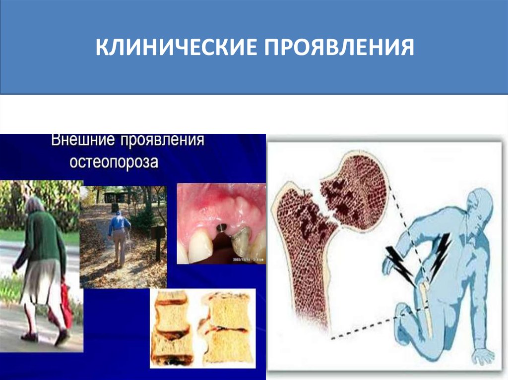 Симптомы остеопороза. Клиническая картина остеопороза. Клинические проявления остеопороза. Остеопороз клиника симптомы. Клиника при остеопорозе.