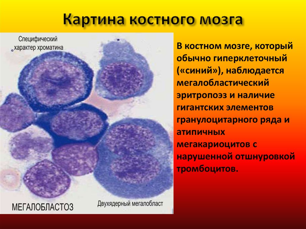 Пораженный костный мозг. Мегалобластная анемия костный мозг. Мегалобласты и мегалоциты. Костный мозг (мазок) (по Романовскому).