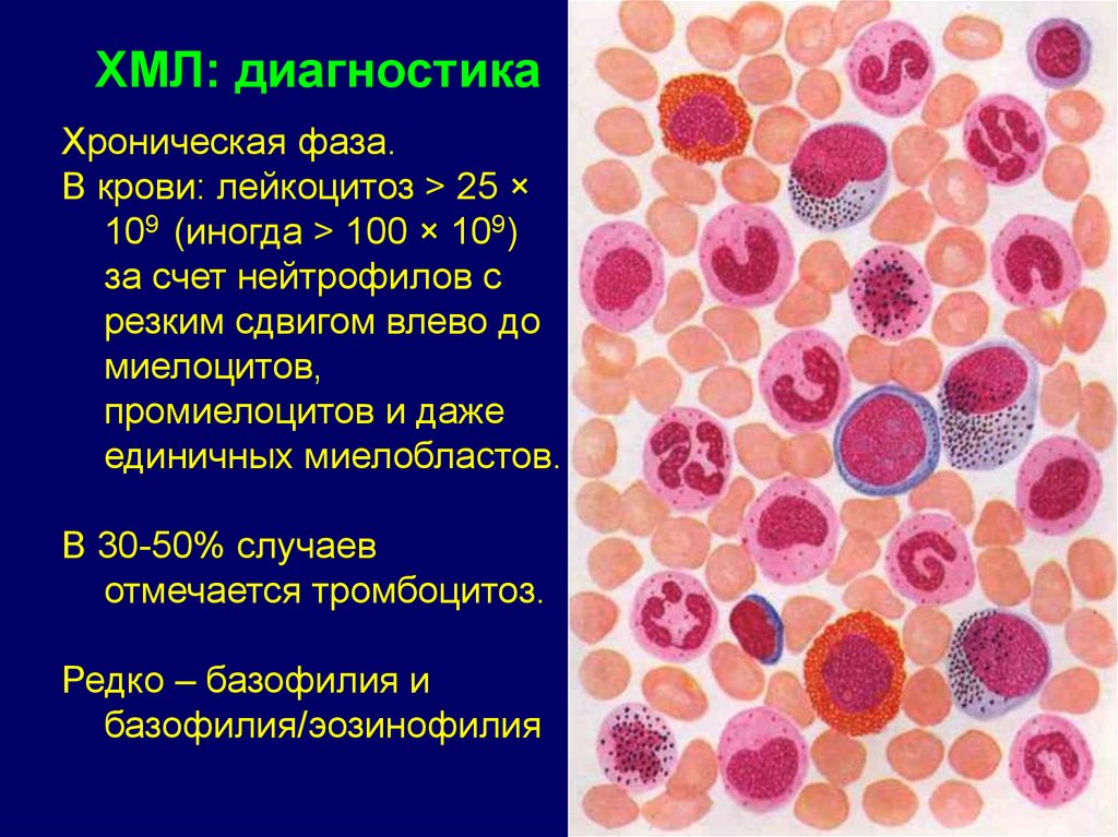 4 лейкоцитоз. Базофилия и эозинофилия. Хронический миелолейкоз хроническая фаза. Картина крови при хроническом лимфолейкозе.
