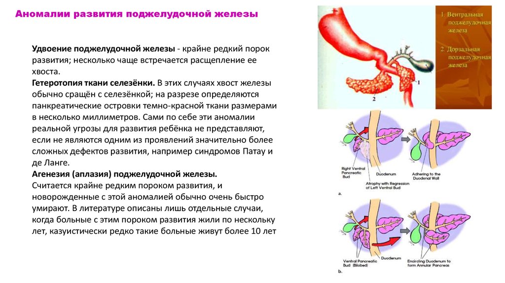 Расшифровка поджелудочной железы. Аномалии развития поджелудочной железы. Недоразвитие поджелудочной железы. Порок развития поджелуд железы. Пороки развития печени и желчевыводящих путей.