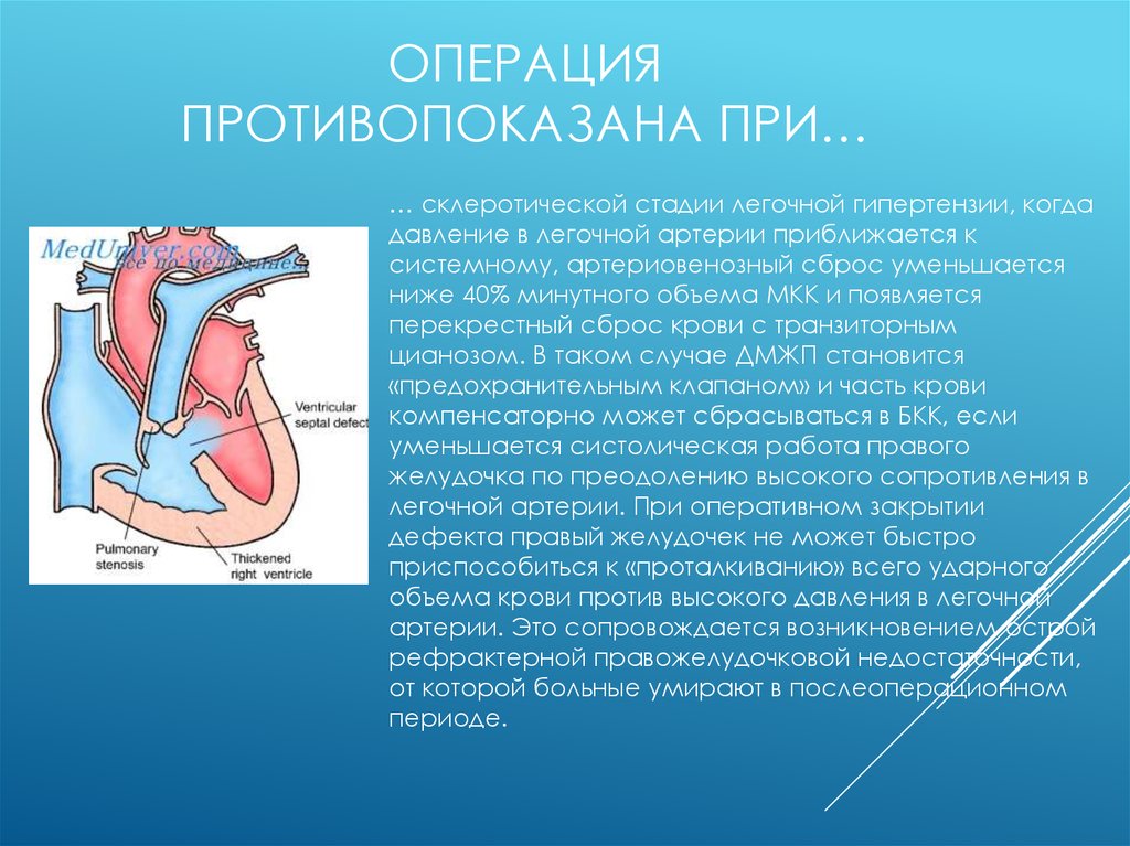 Дефект межжелудочковой перегородки презентация