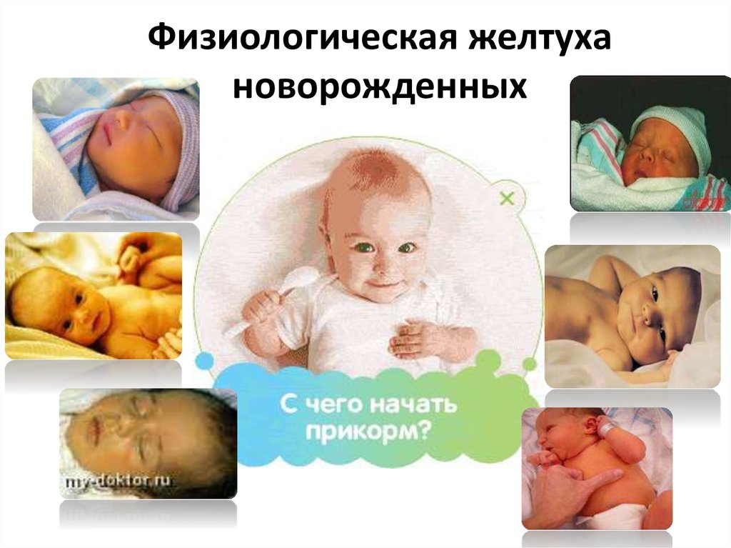 Желтушка новорожденных сколько дней. Физиологическая и патологическая желтуха новорожденных. Физиологическая желтушка у новорожденного. Желтушка у новорожденных физиологическая и патологическая. Физиологическая елтуха у новорождённого.