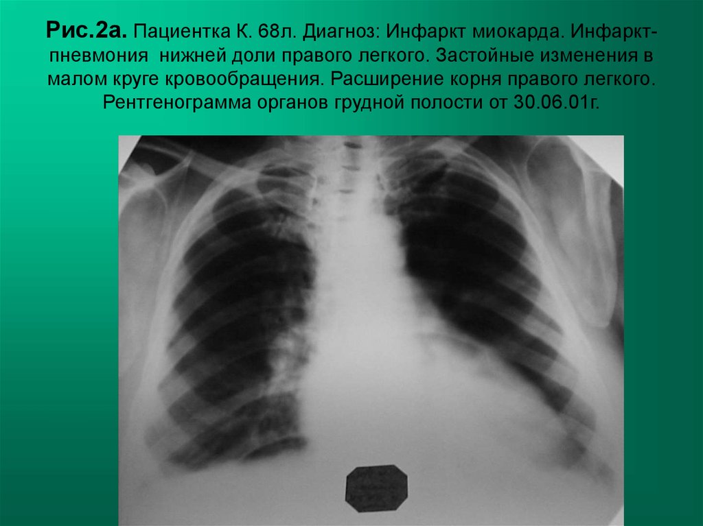 Пневмония в правом легком в нижней доле. Инфаркт-пневмония легкого рентген. Инфаркт лёгкого на рентгенограмме. Инфарктная пневмония на рентгенограмме. Застойные явления в легких рентген.