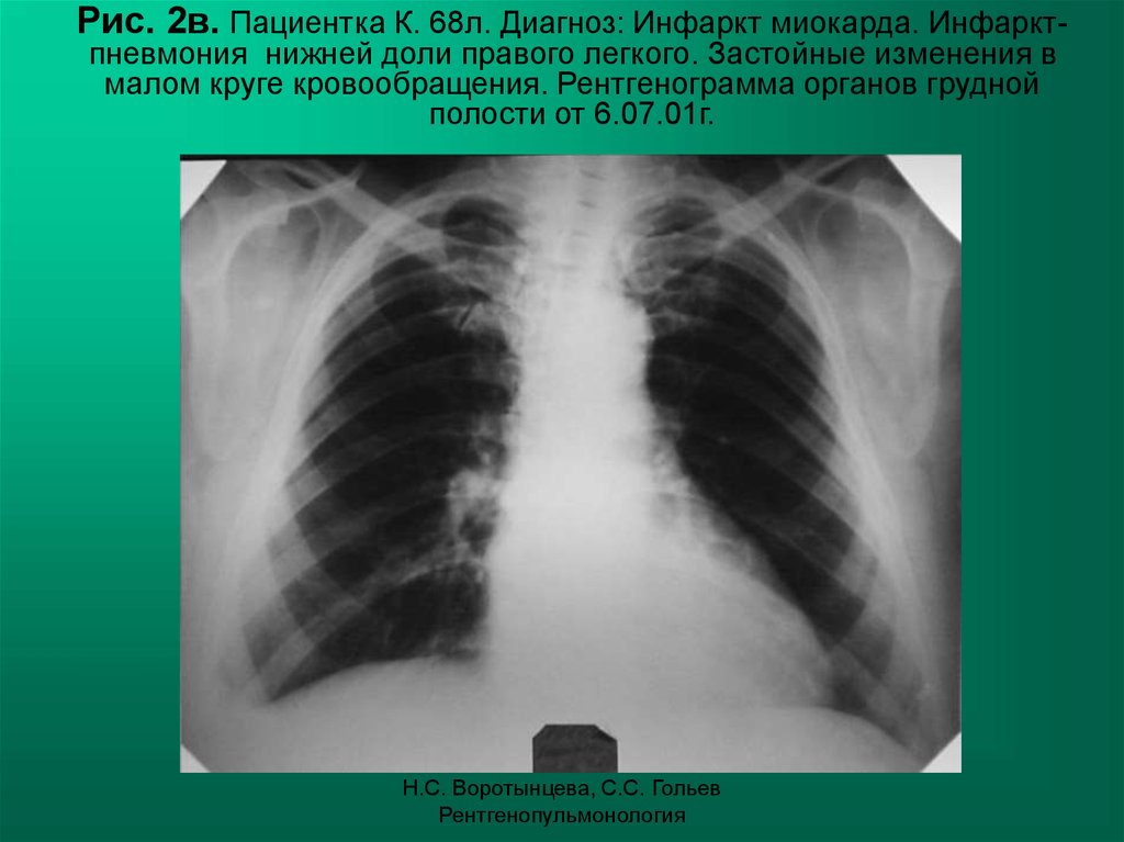 Пневмония в правом легком в нижней доле. Инфаркт легкого на рентгенограмме.
