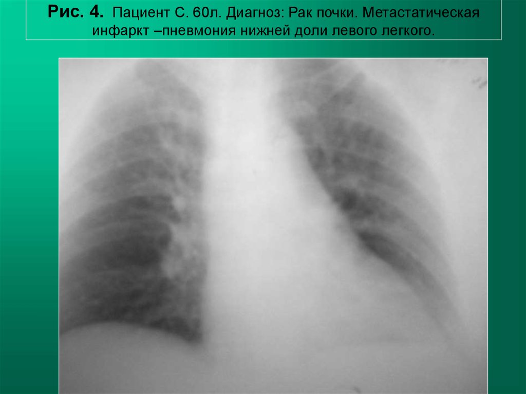Пневмония в правом легком в нижней доле. Воспаление нижних долей легких. Инфарктная пневмония рентген.