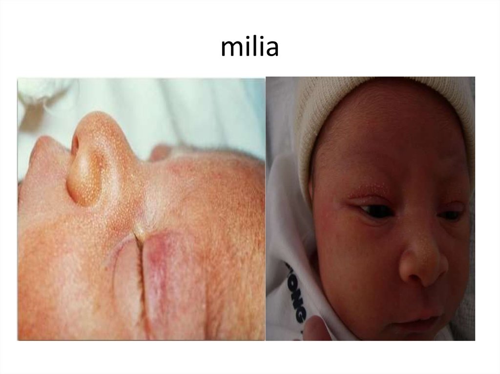 milia