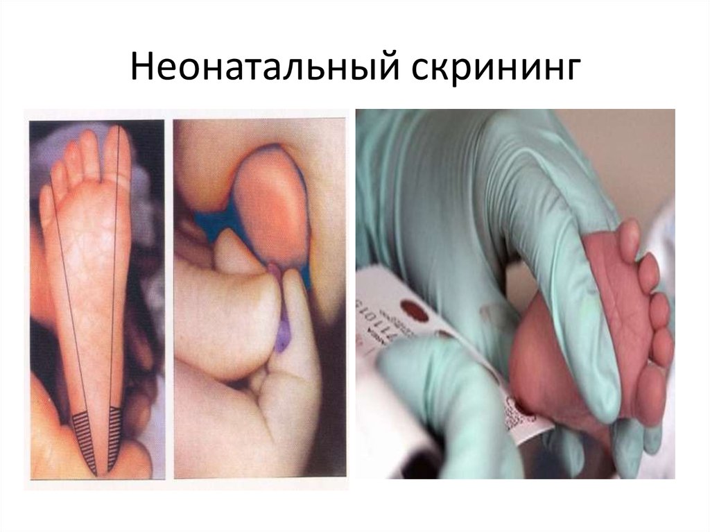 Неонатальный скрининг