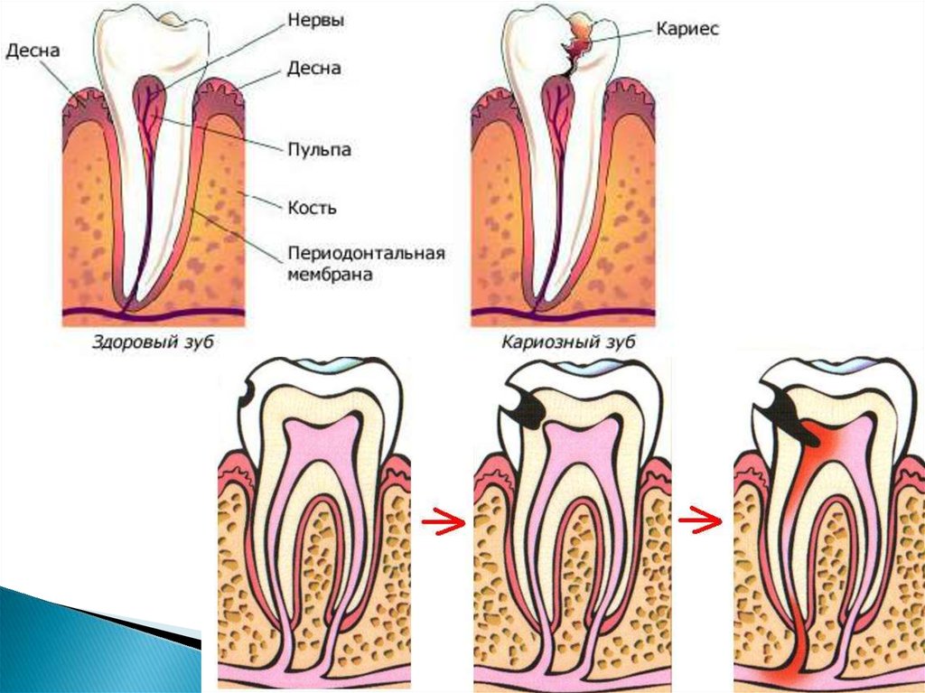 Пульпит и кариес отличия. Лечение кариеса поэтапно протокол. Большая дырка в зубе на зуб не болит. Те кто не чистит зубы кариес. Если зуб без нерва подмывает.