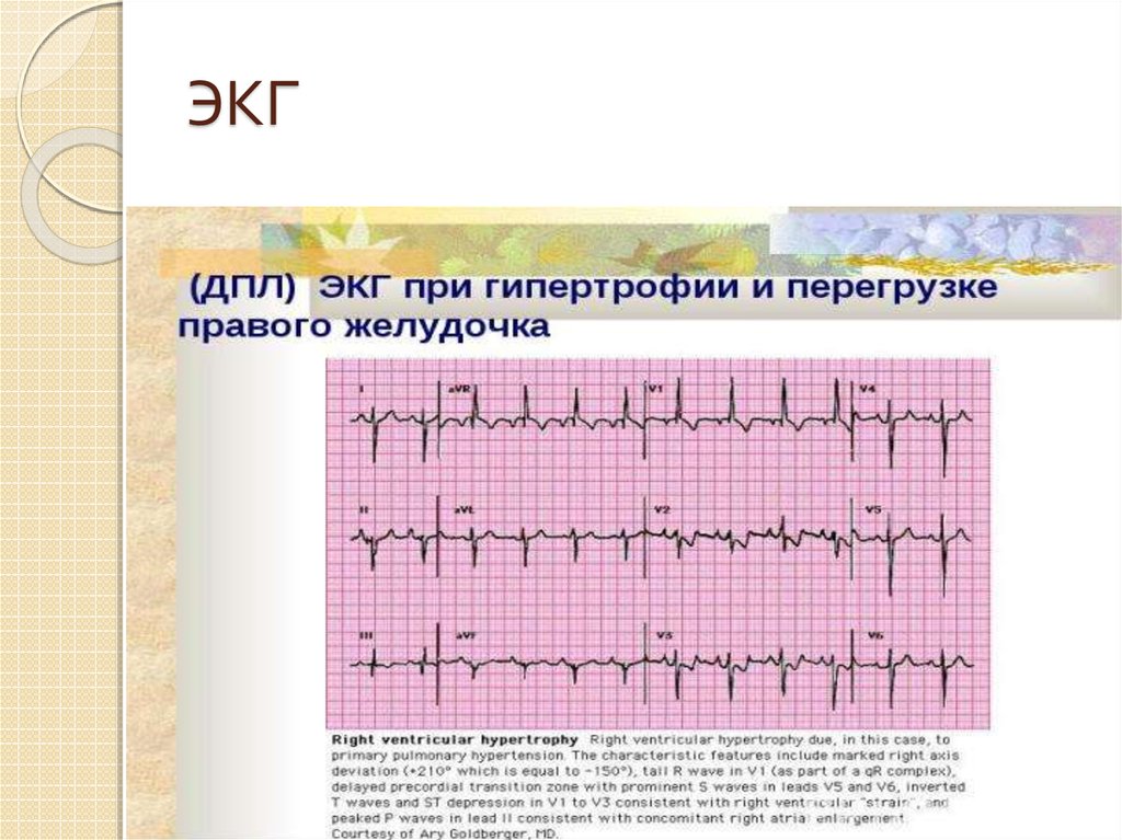 Диастолическая перегрузка левого желудочка на экг картинка