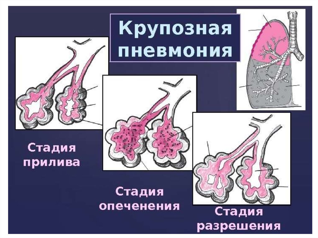 Стадии пневмонии. 4 Стадии крупозной пневмонии. Стадия разрешения при крупозной пневмонии. Крупозная пневмония стадия прилива. Крупозная пневмония стадия разрешения.