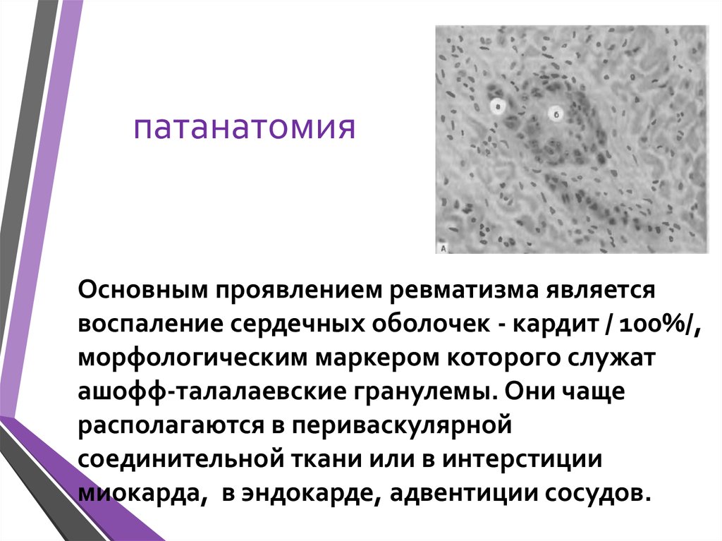 Ревматизм патанатомия презентация