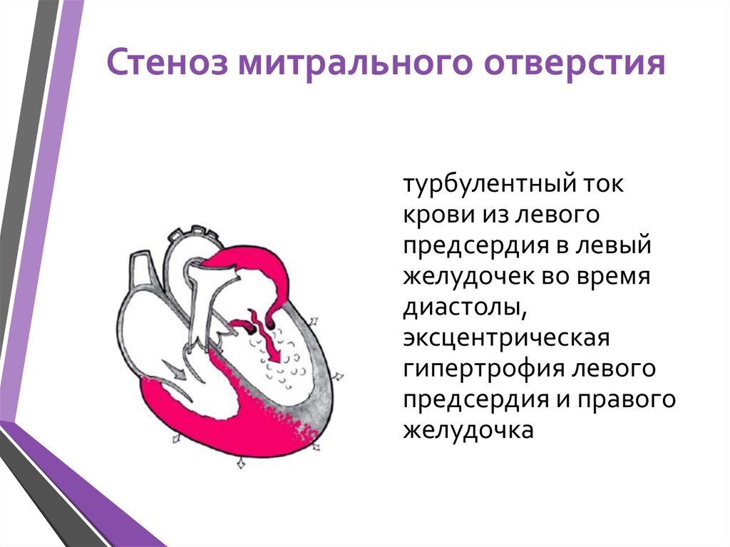 Митральная стеноз презентация