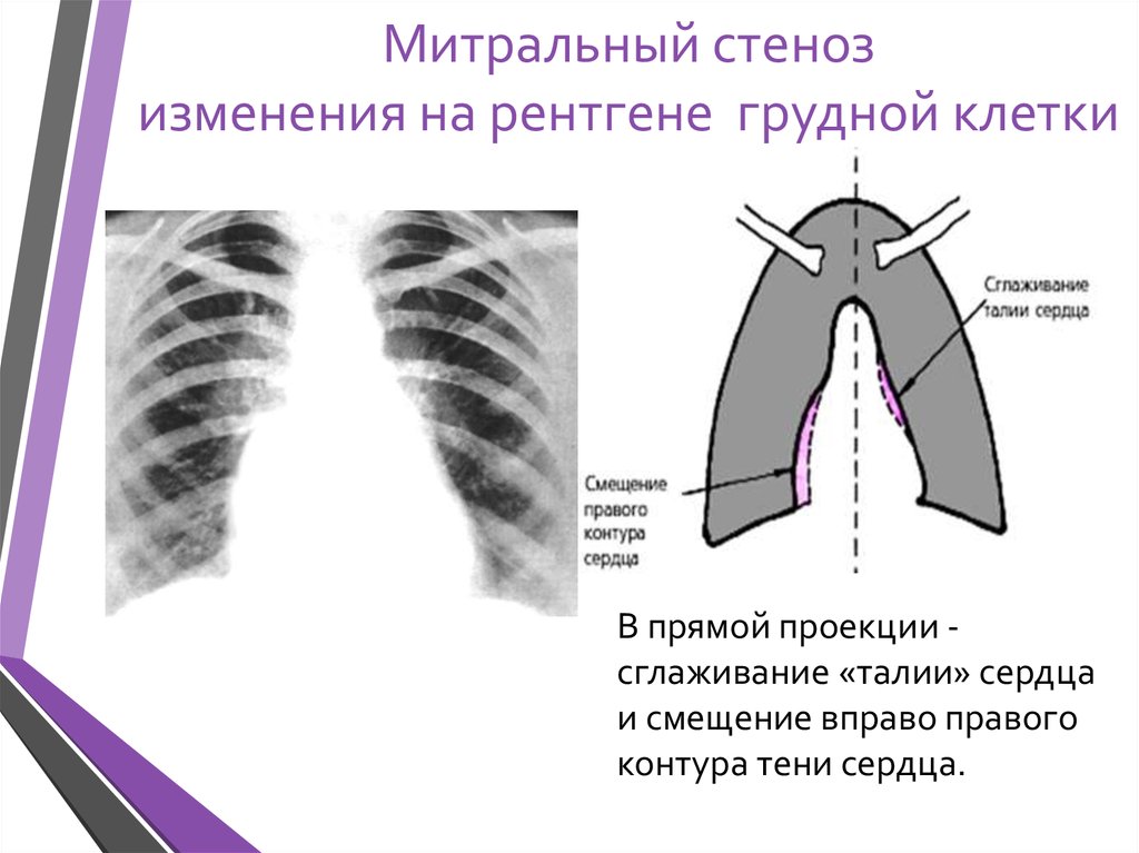 Митральное сердце. Митральная конфигурация рентген. Митральный порок сердца рентген. Патологические конфигурации сердца рентген. Стеноз митрального отверстия с изменениями в легких рентген.