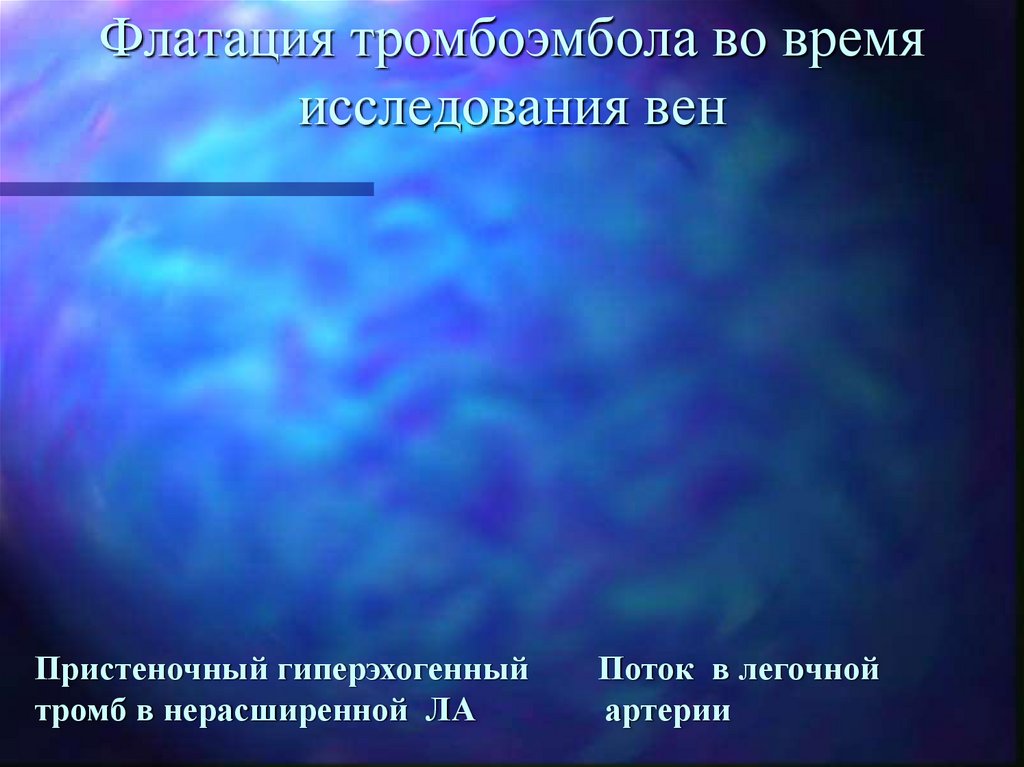 Флатация тромбоэмбола во время исследования вен