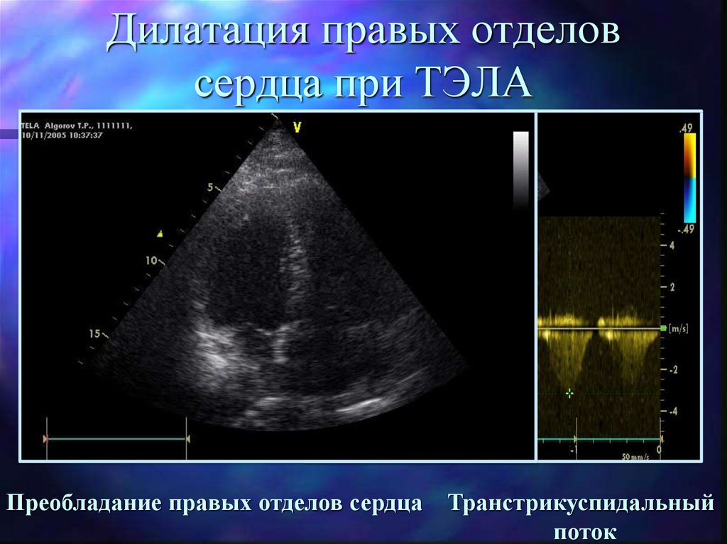 Дилатация правых отделов. Дилатация правых отделов сердца у новорожденных. Дилатация всех отделов сердца. Дилатация правых отделов сердца причины.