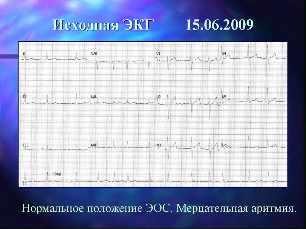 Исходная ЭКГ 15.06.2009