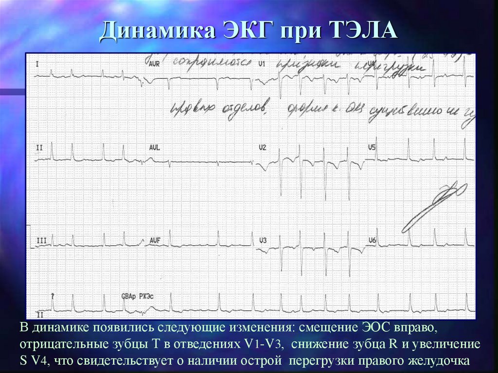 Перегрузка правого желудочка