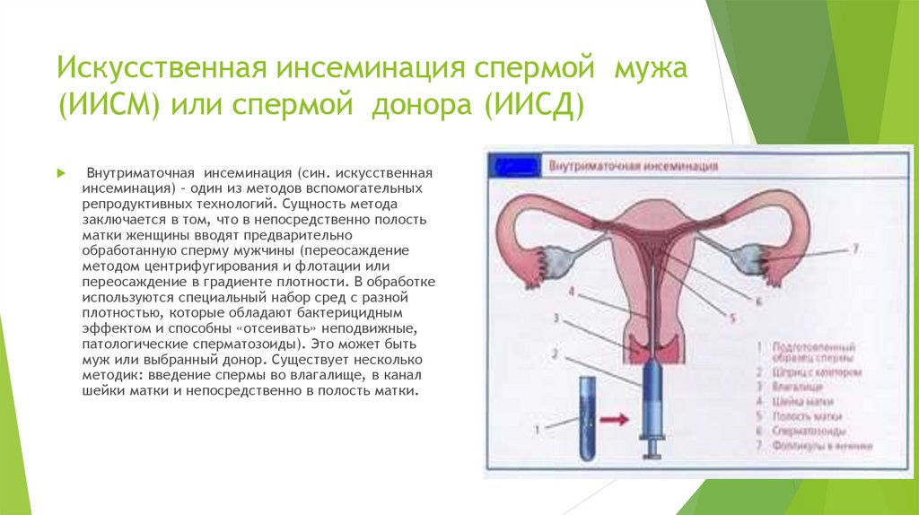 Искусственная инсеминация спермой мужа (ИИСМ) или спермой донора (ИИСД)