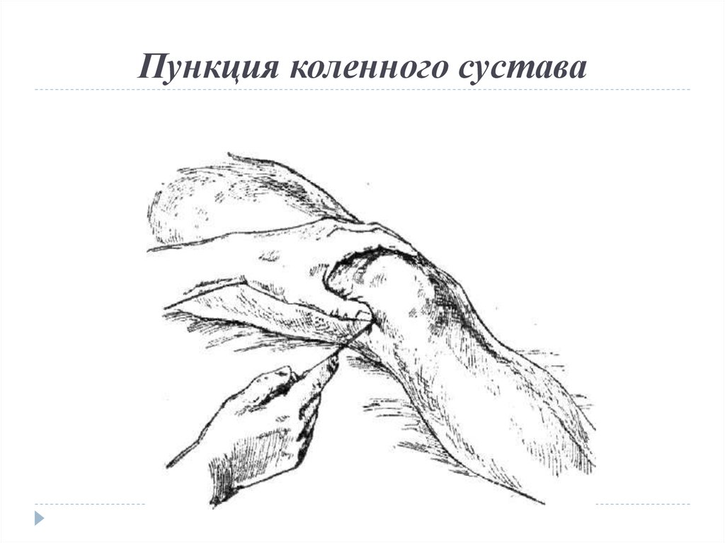 Пункция коленного сустава. Пункция верхнего заворота коленного сустава. Пункция коленного сустава точки пункции. Пункция коленного сустава техника. Верхнелатеральная пункция коленного сустава.