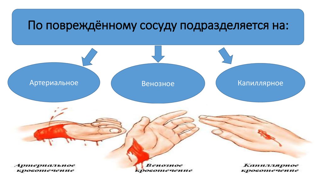 Рассмотрите рисунок с изображением повреждений кровеносных сосудов какой сосуд поврежден на третьем