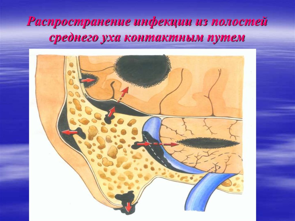 Отогенные внутричерепные осложнения презентация