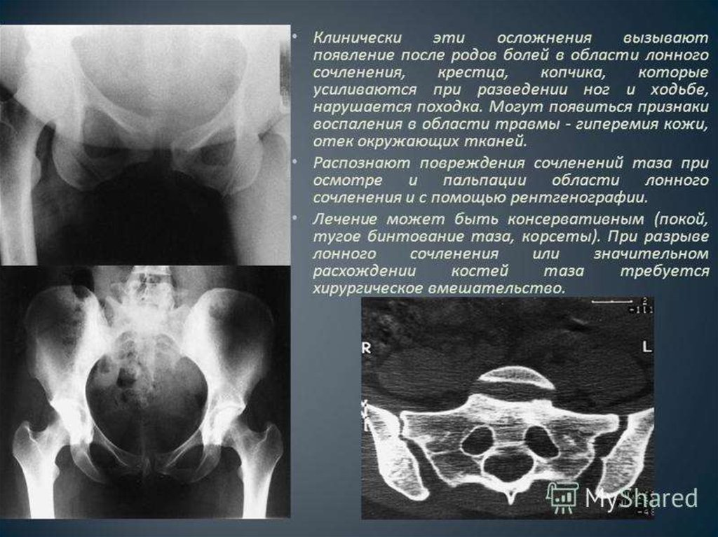 Узи лонного. Расхождение костей симфиза. Разрыв лонного сочленения рентген. Симфизит расхождение лонного сочленения. Расхождение лонного сочленения при беременности симптомы.