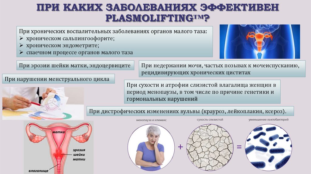 Плазмолифтинг Интимной Зоны Фото