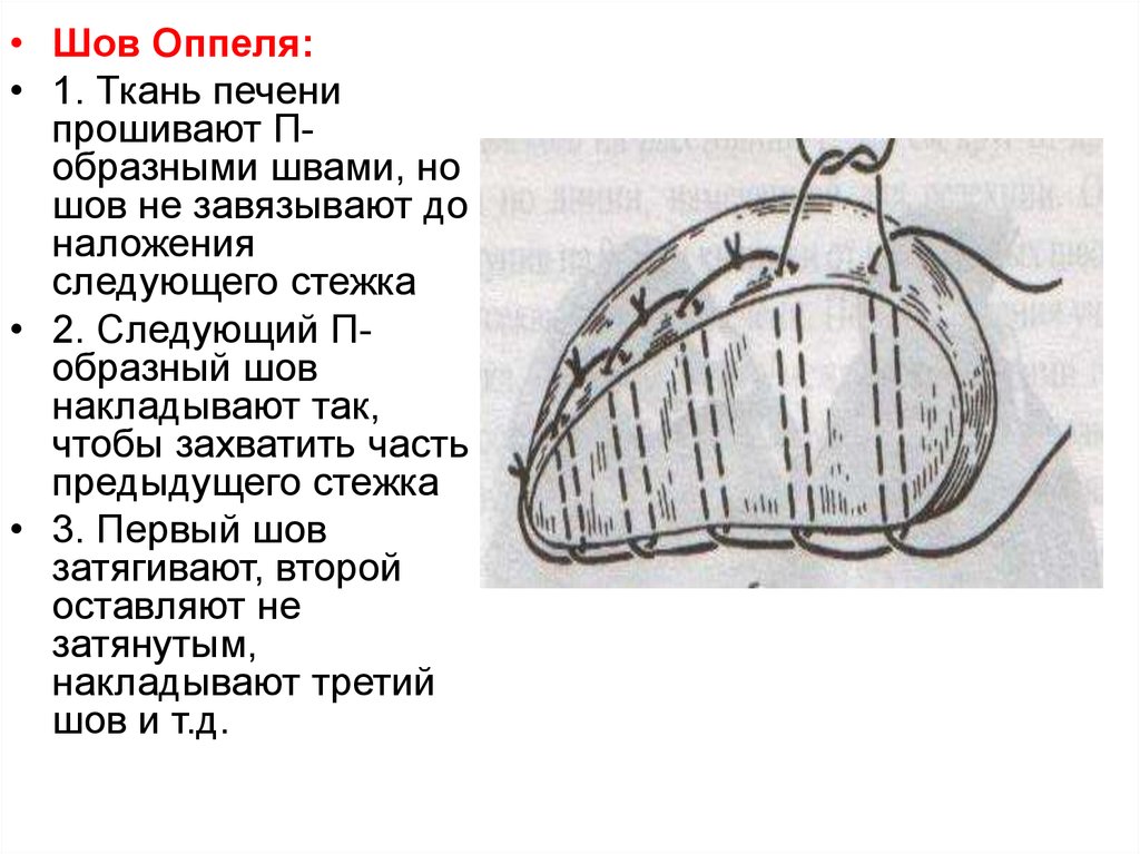 Ткань паренхиматозных органов. П образный шов на ткани.