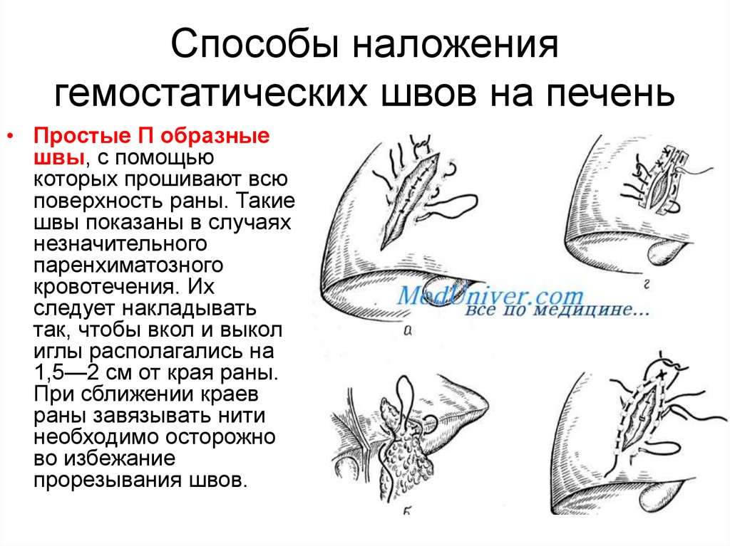 Способ наложения. Наложение гемостатических швов. Гемостатические швы печени. Гемостатический ШОК.