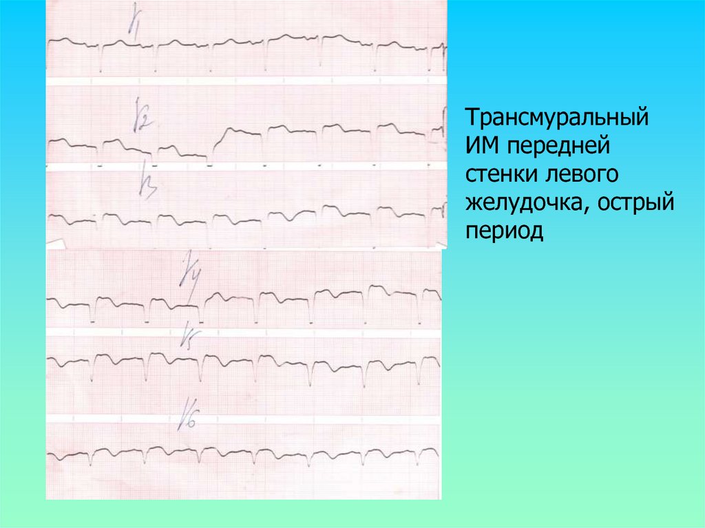 Изменение передней стенки левого желудочка. Острый трансмуральный инфаркт передней стенки на ЭКГ. Острый трансмуральный инфаркт нижней стенки миокарда. Инфаркт миокарда трансмуральный нижней стенки 121.1. Острый трансмуральный q-инфаркт передней стенки миокарда.