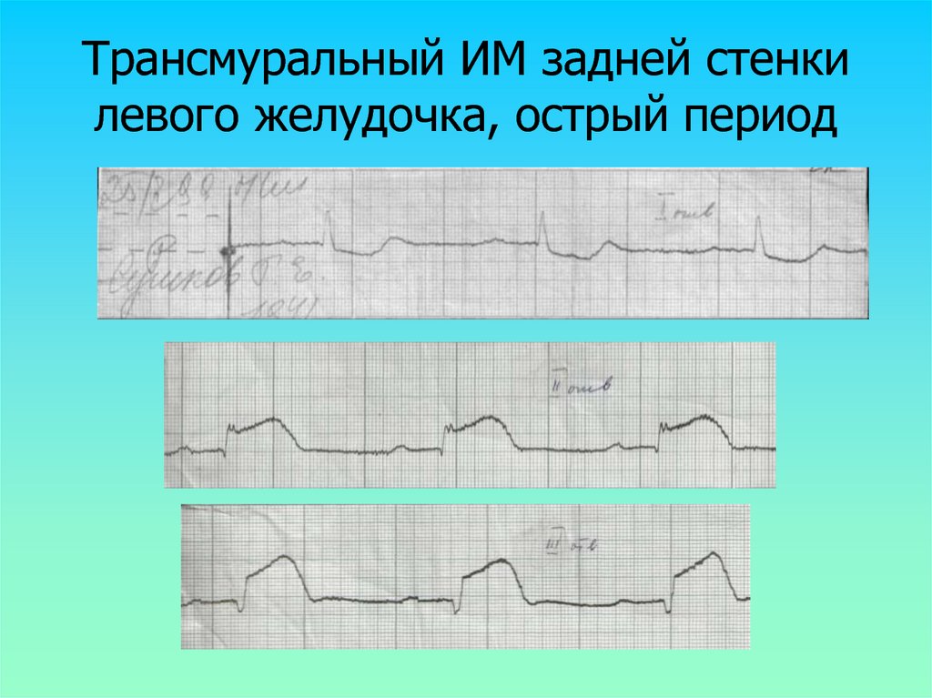 Нижняя стенка левого желудочка. Задний трансмуральный инфаркт миокарда ЭКГ. ЭКГ острый инфаркт боковой стенки. Трансмуральный инфаркт миокарда передней стенки на ЭКГ. Трансмуральный инфаркт миокарда задней стенки.